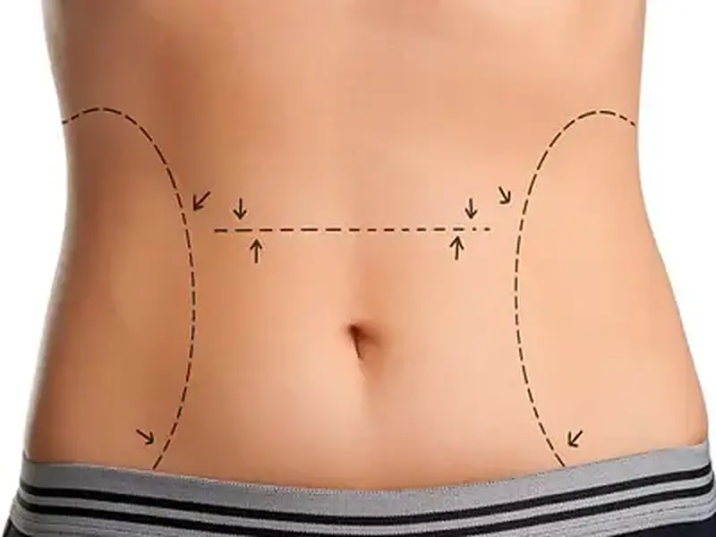 Abdominoplastia: A arte de remodelar o abdômen
