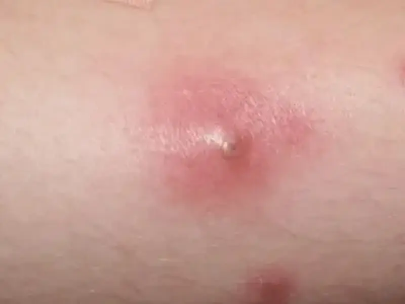 Abscesso