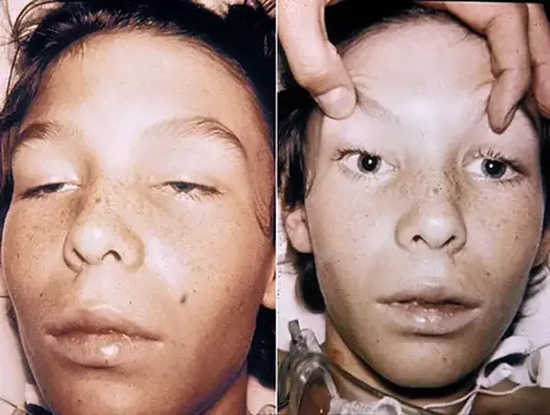 Botulismo: Uma rara e grave doença
