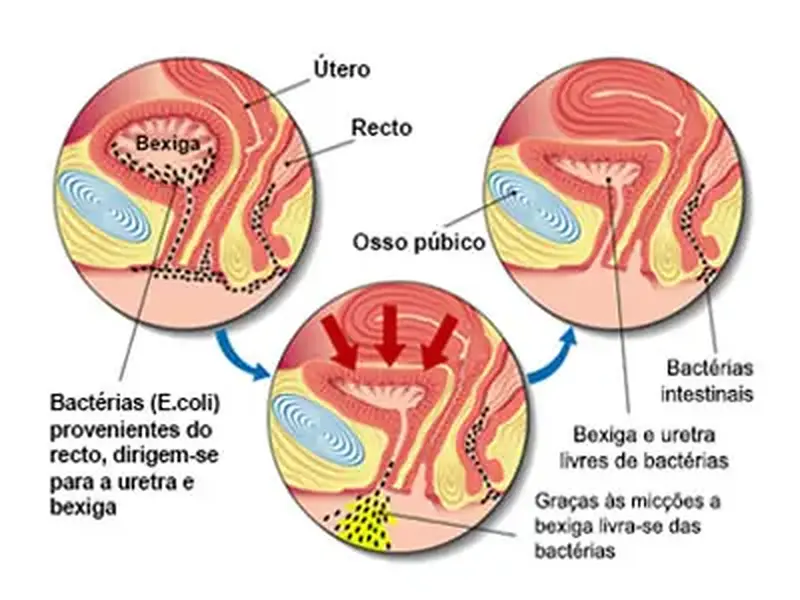 Cistite: A Infecção urinária que chega à bexiga