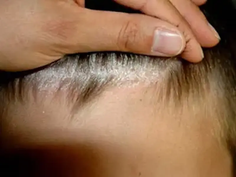 Dermatite seborreica: Não é falta de higiene
