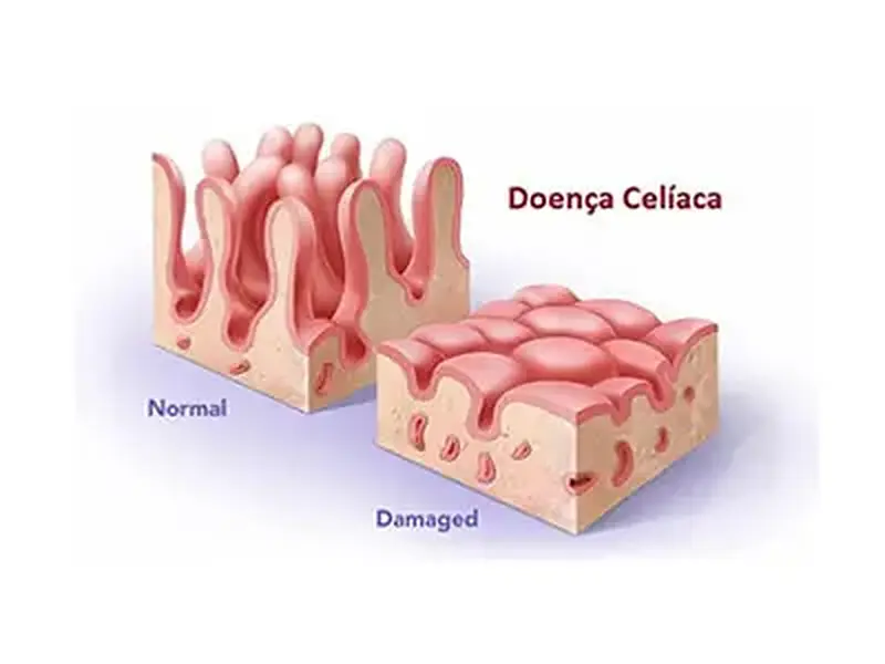 Doença Celíaca