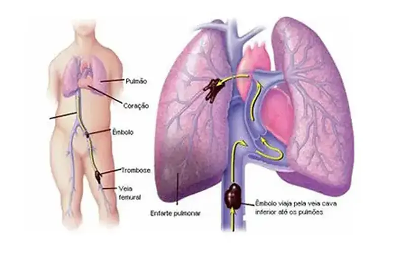 Embolia pulmonar: O risco da coagulação