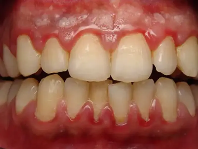 Gengivite: A inflamação das gengivas