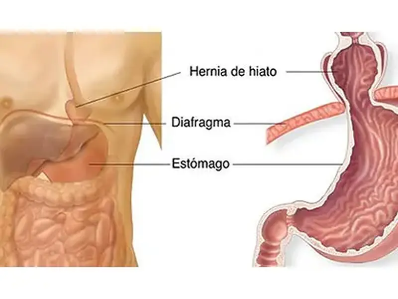 Hérnia de hiato: Quando o estômago vai para o lugar errado