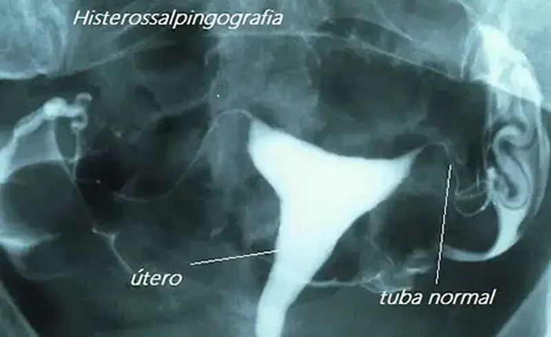 Histerossalpingografia