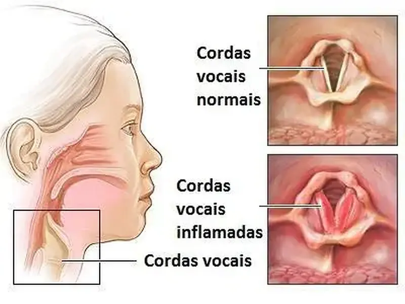 Laringite: Causas, sintomas e complicações