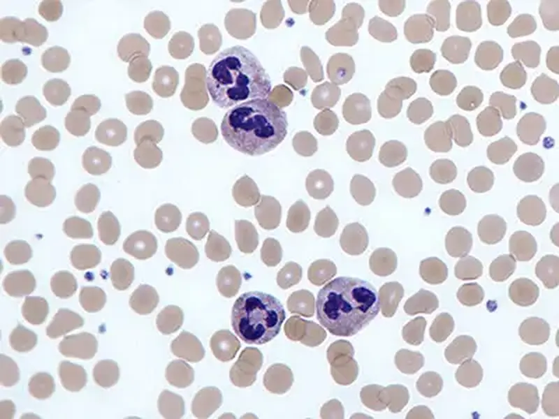 Leucocitose - O que é? Conheça as causas, sintomas e diagnóstico