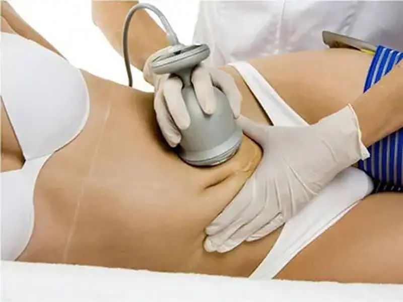 Lipocavitação
