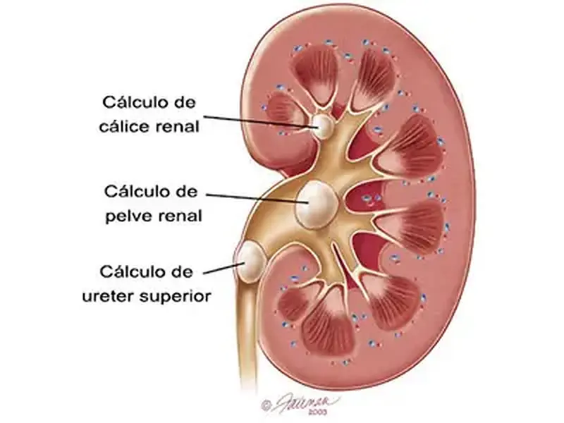 Litíase renal: Tipos, sintomas e tratamentos