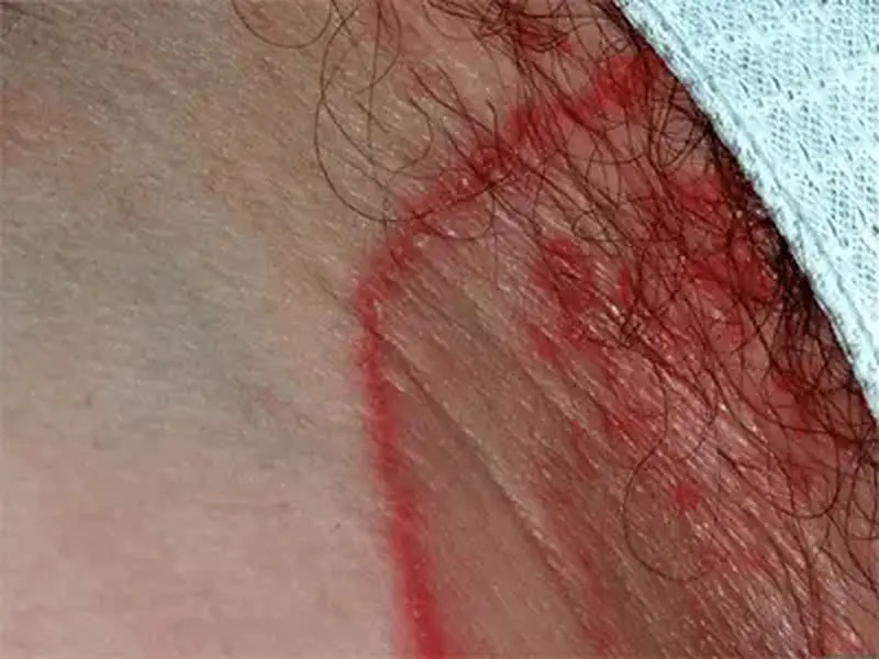 Micose na Virilha - Qual Pomada Usar? Tratamento Caseiro, Sintomas, Prevenção!