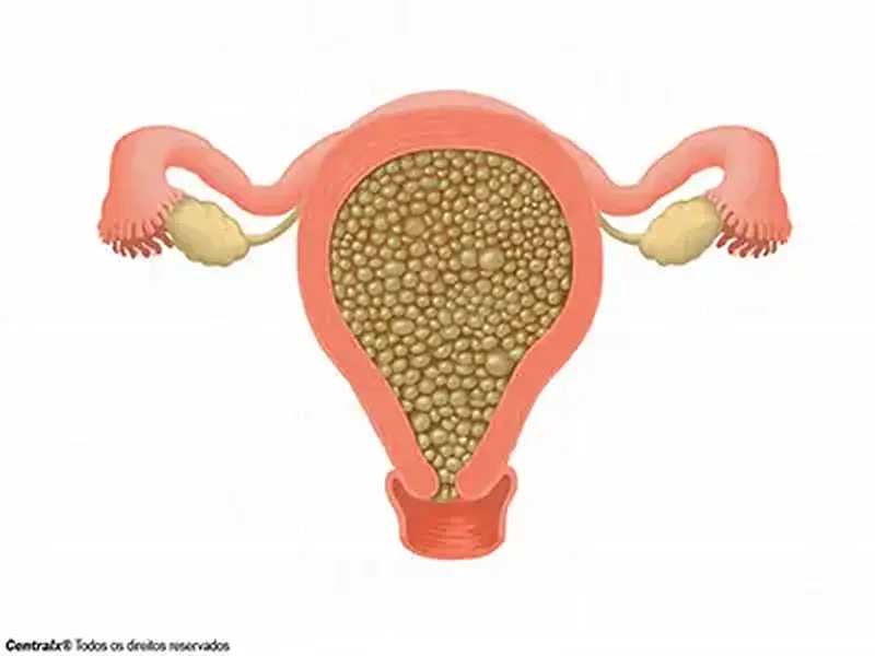 Mola Hidatiforme - O Que É? Causas, Tratamento, Sintomas, Prevenção!