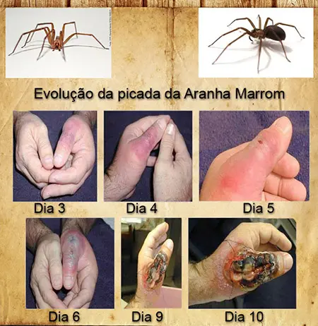 picada aranha marrom