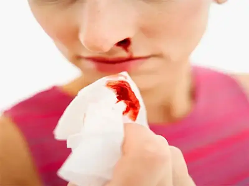 Sangramento Nasal - O Que Fazer? Tratamento, Causas, Prevenção!