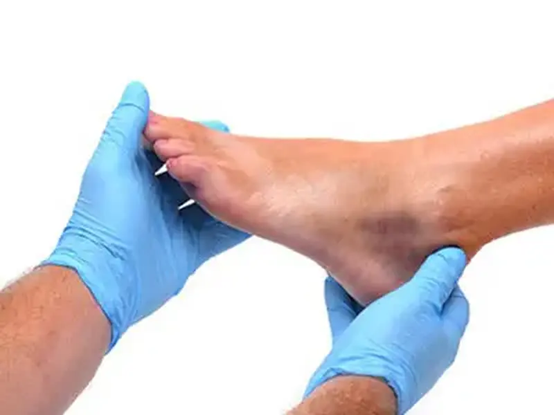 Mãos com luvas azuis pressionando o tornozelo inchado de um paciente para avaliar o edema