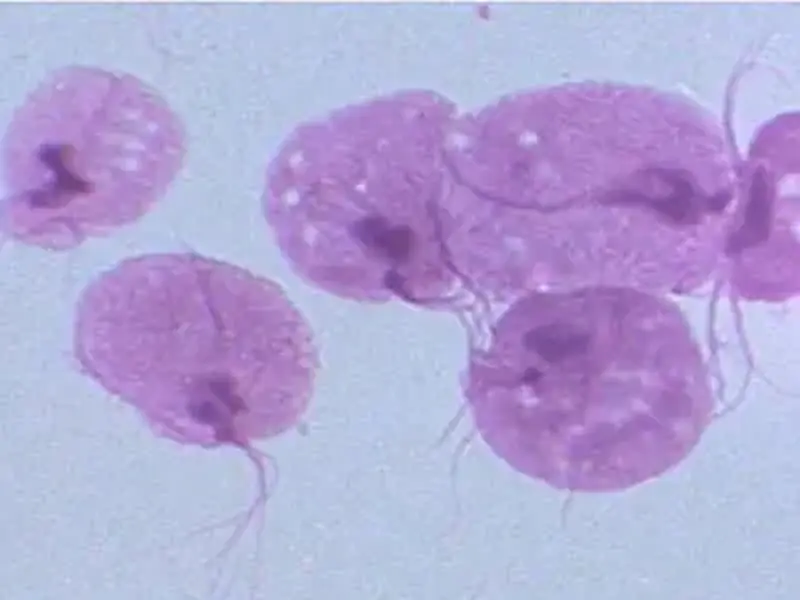 Tricomoníase